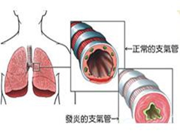 支氣管哮喘典型的臨床癥狀是,支氣管哮喘的典型臨床癥狀與實地考察數據策略在游戲版的應用,未來解答解析說明_投資版54.80.74