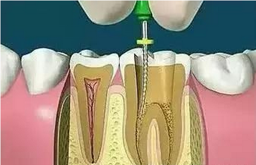 慢性牙髓炎急性發(fā)作的臨床表現(xiàn)